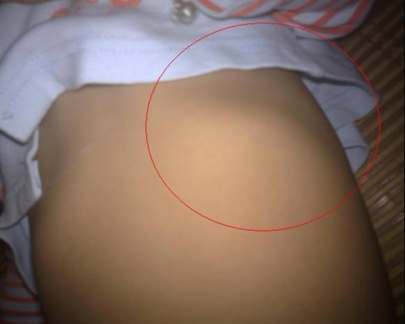 宝宝肋骨外翻是什么原因不缺钙,宝宝缺钙引起的肋骨外翻怎么办