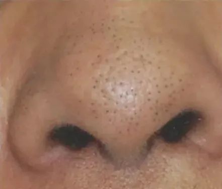 去除又黑又硬的黑头的方法,怎么祛除黑头的最有效方法