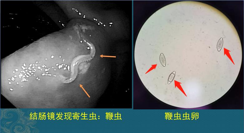 吃出来的大肠寄生虫，只因做错1件事，医生说生菜要冲洗干净