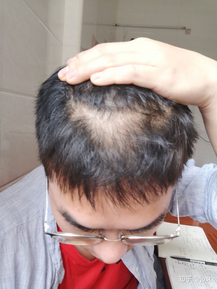 雄激素脱发单用米诺地尔,米诺地尔治女性脱发案例