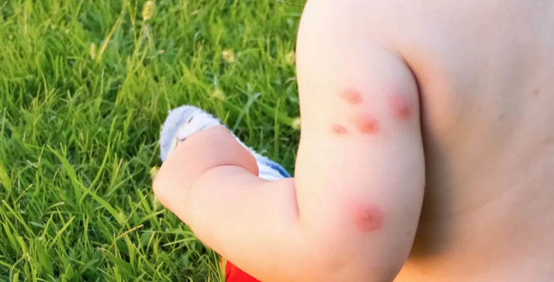 用炉甘石洗剂皮肤变干了怎么办,儿童皮肤问题抹什么药膏