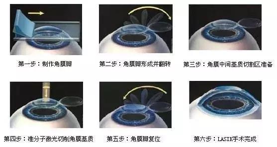 激光近视手术直视如何练习,激光近视手术做之前需要什么准备