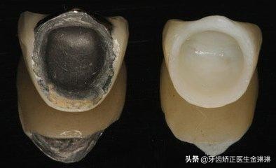 做的烤瓷牙根部发黑了怎么回事,烤瓷牙为什么牙根会变黑
