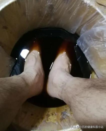 辨证论治，内外皆用，聊一聊中医治疗足癣病的用药思路