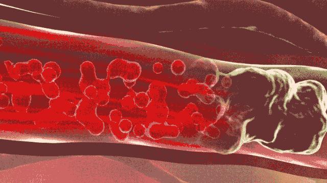 不想搭桥是否可以保守治疗,年轻人心梗支架与溶栓哪个好