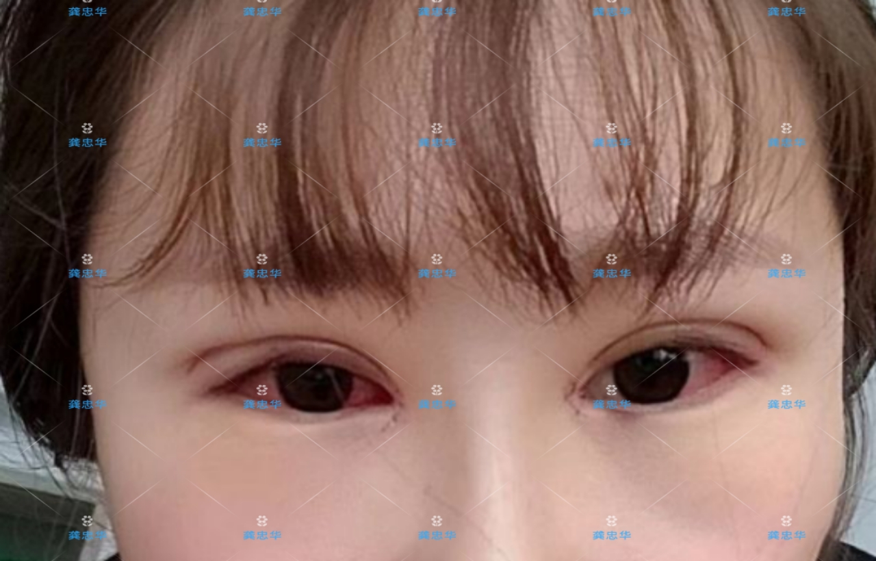 眼皮松弛可以做埋线双眼皮吗,埋线双眼皮眼皮松弛了该怎么办