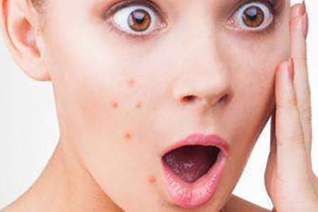 孕期长痘的正确消除方法,孕期长痘是什么原因怎么解决