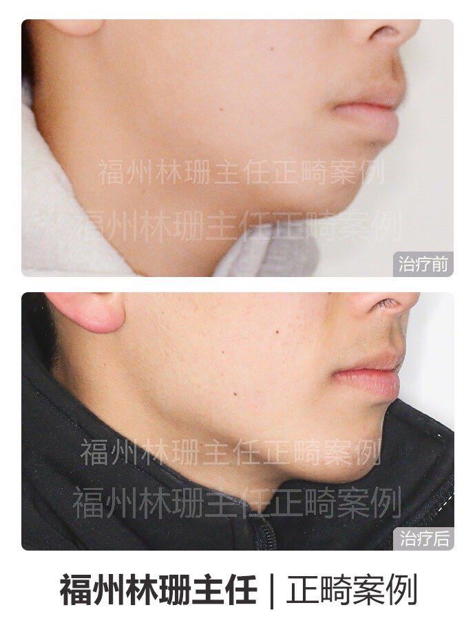 福州牙齿矫正林珊主任｜浅谈下颌后缩