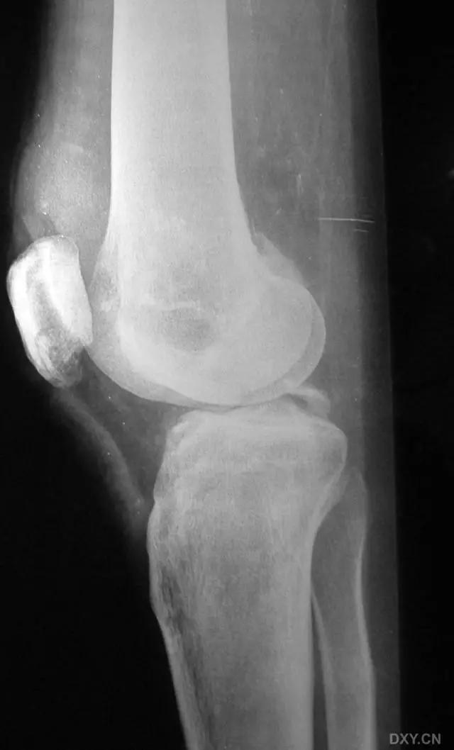 特殊骨折类型,特殊骨折体征