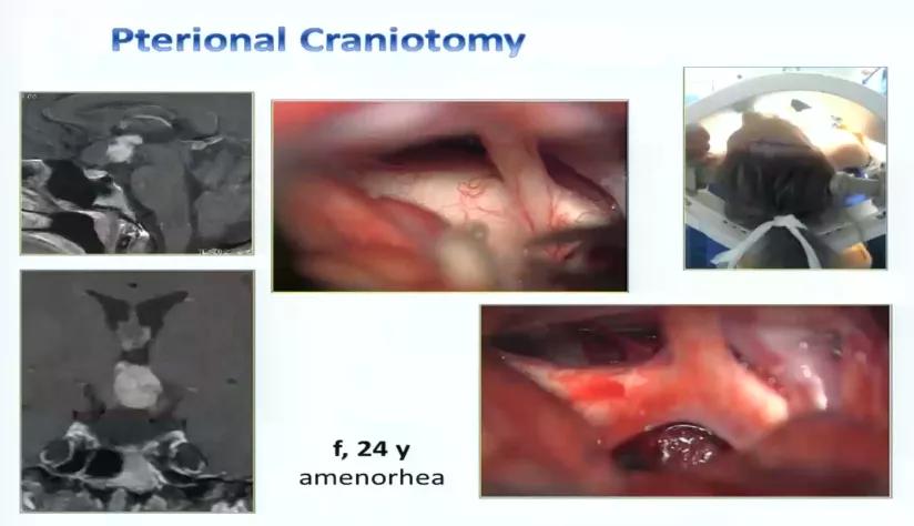 INC巴特朗菲教授视频|视神经-下丘脑胶质瘤全切案例集及治疗解读