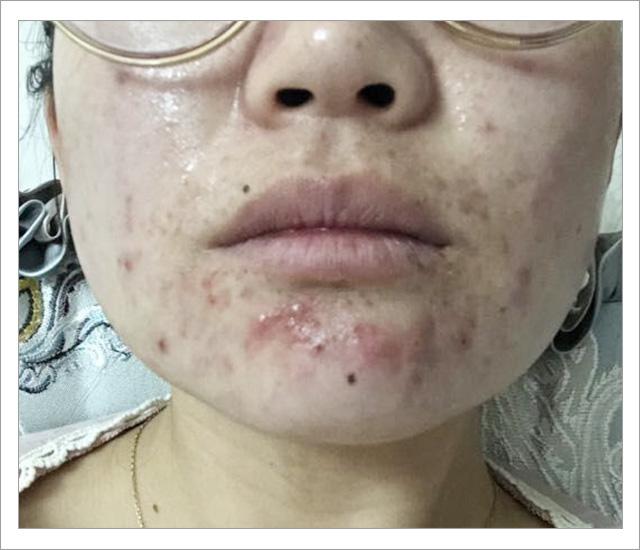 根除脸上螨虫的简单方法,螨虫在脸上如何彻底消除