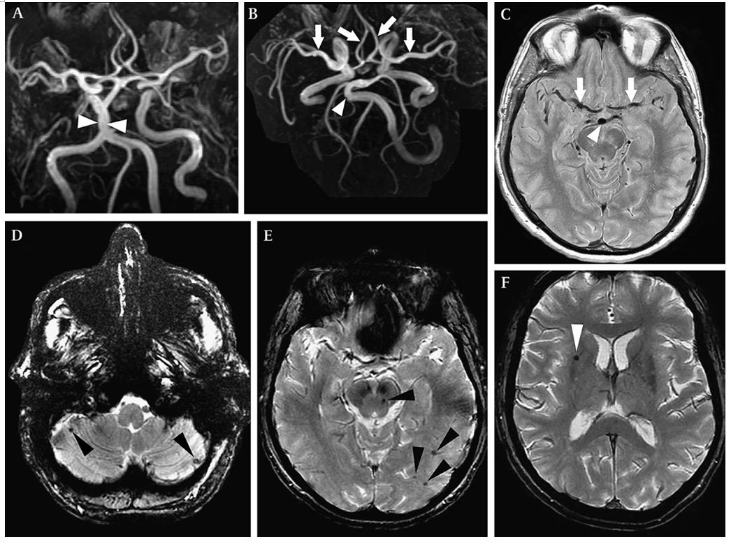 头疼做磁共振脑小血管有点出血,核磁共振说脑血管出血
