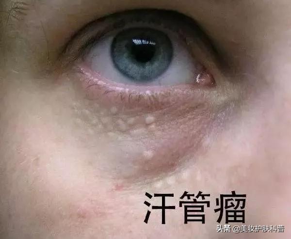 容易长脂肪粒用什么眼霜,为什么一用眼霜就长脂肪粒