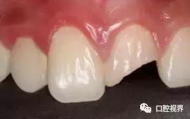 门牙撞了怎么办,门牙意外损坏怎么办