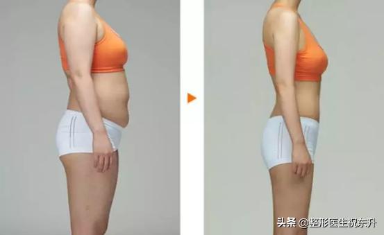 吸脂手术的优缺点,吸脂手术的副作用和危害