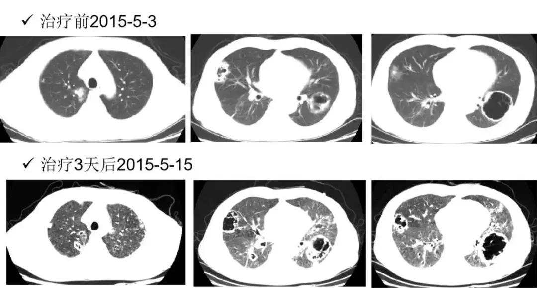 PCCM直播丨中年装修工人双肺多发空洞，奴卡菌＋曲霉菌如何治疗？