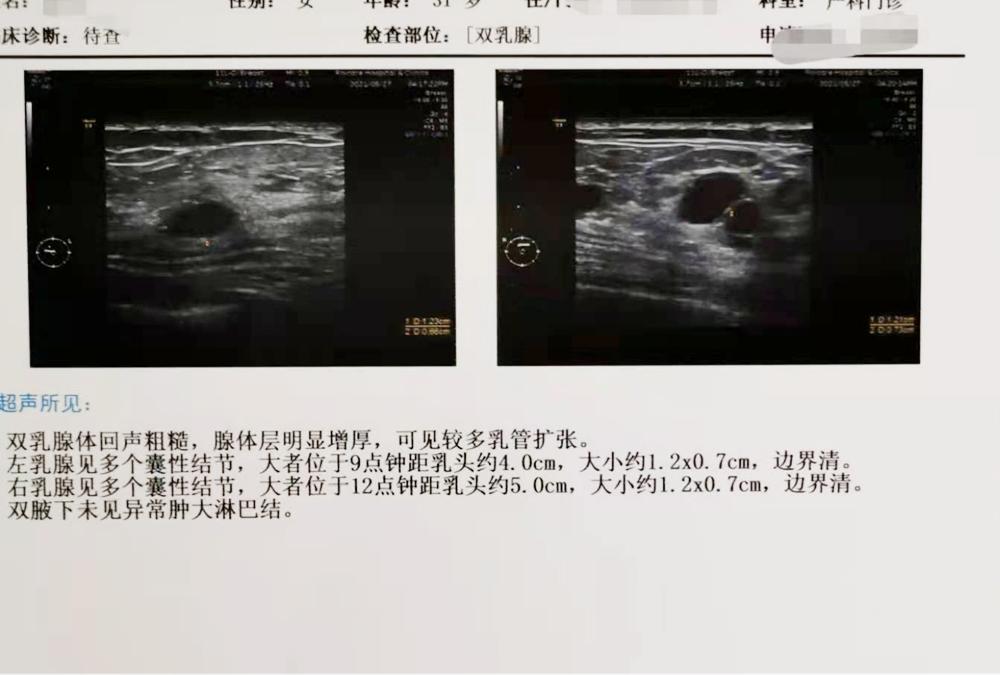 哺乳期乳房疙疙瘩瘩，影响喂奶吗？