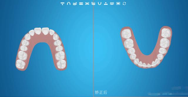 隐形矫正和传统的矫正有什么区别,舌侧矫正和隐形矫正哪个费用高