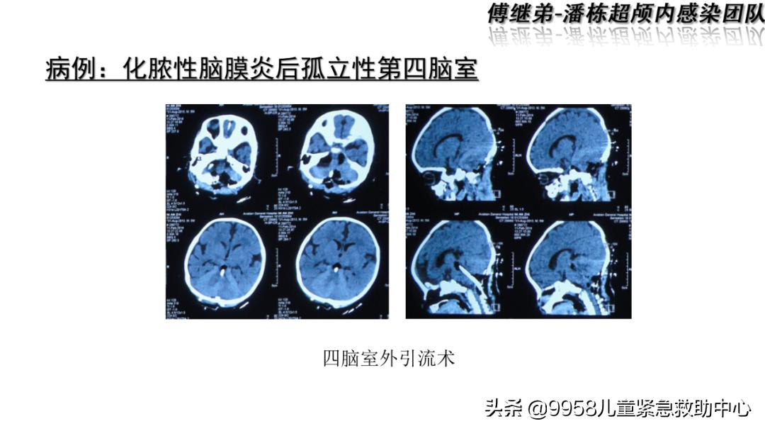 颅内感染康复治疗知识,小儿颅内感染的健康宣教