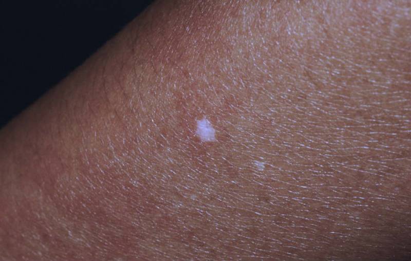 乳红色的白斑是不是白癜风,医生说我的白斑是白癜风能信吗