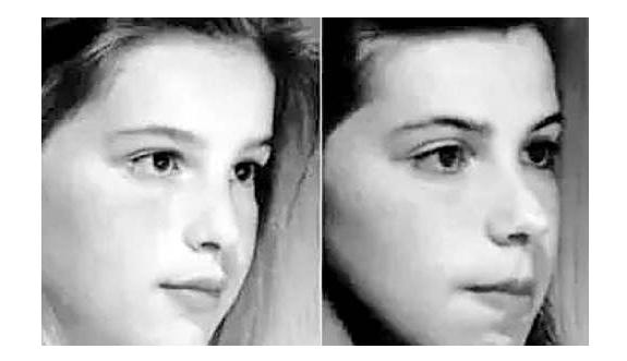 家中有孩子打鼾家长要警惕这个病,有没有腺样体肥大的家长