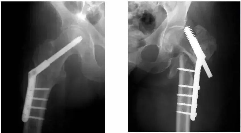 老年髋部骨折最常见的部位,髋部骨折危害大老年人摔伤要重视