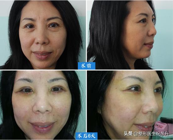 眼袋困扰多年不要急试试这个方法,消除眼袋也有省钱又省时的好方法