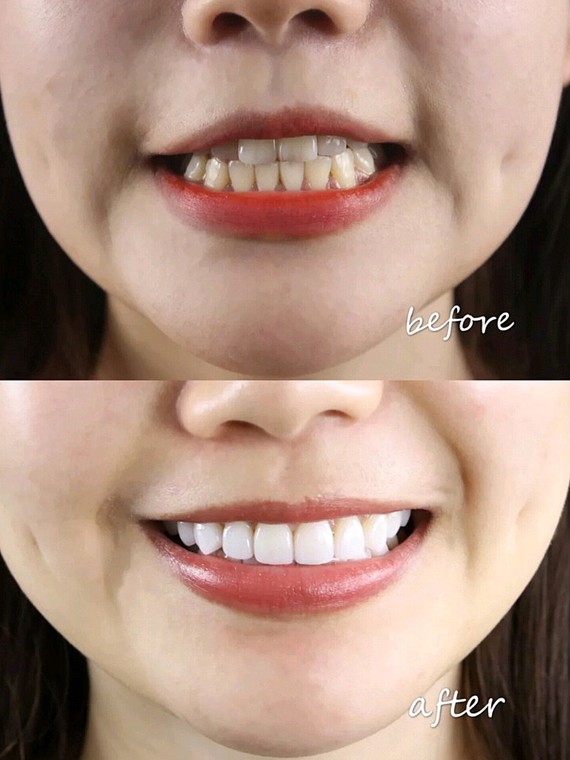 14岁牙齿黄可以洗牙变白吗,牙齿出血发黄去洗牙