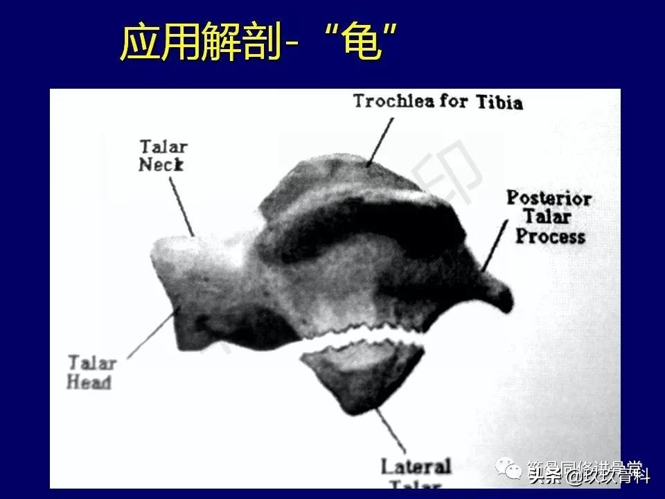 距骨骨折后遗症,距骨骨折怎么办