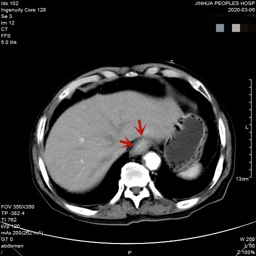 贲门癌80岁手术好还是保守治疗好,医生建议80岁老人做贲门癌手术