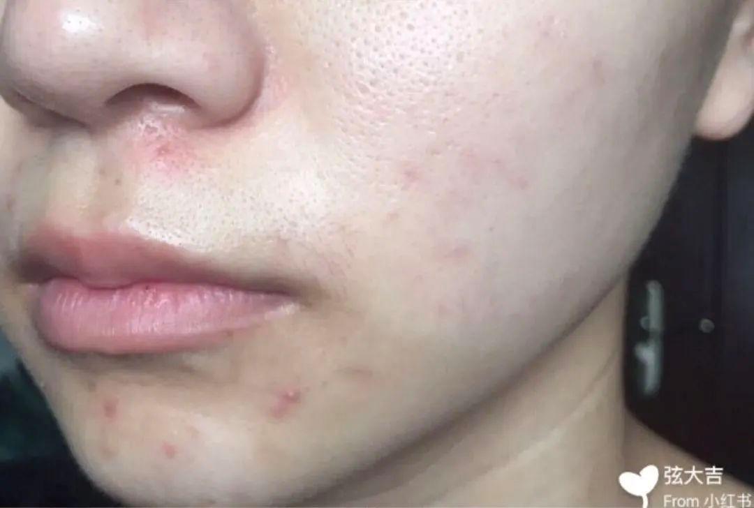 纯干货祛痘指南!低成本、见效快
