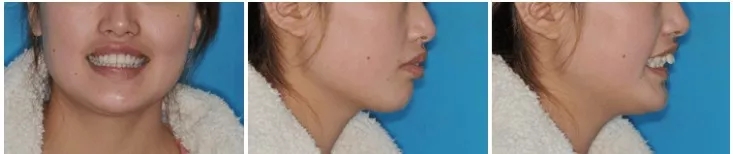 深覆盖vs深覆合,深覆盖和深覆合哪个难度大