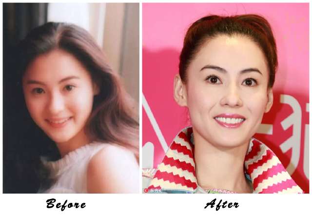 阿娇大龅牙,阿娇整牙