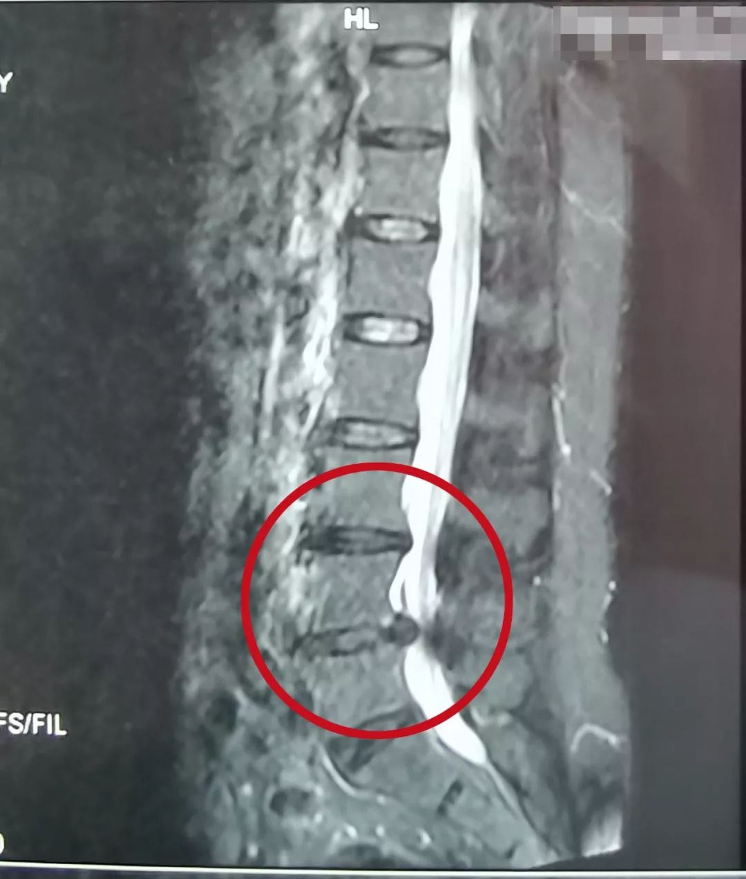 腰椎间盘突出并腰椎管狭窄怎么办,腰椎管狭窄腰椎间盘突出怎么治