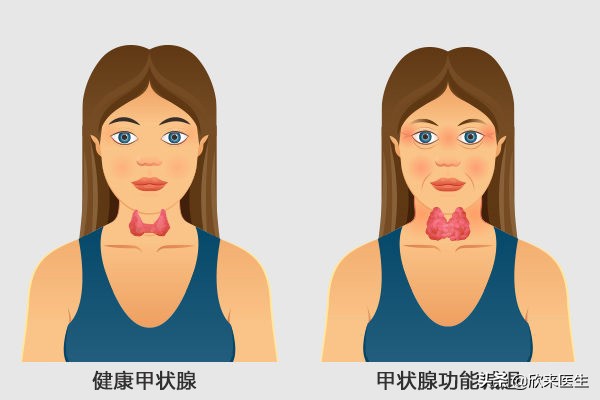 甲状腺功能减退补碘吗,甲状腺功能减退可以吃含碘的盐吗