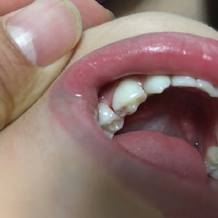 宝宝长牙牙龈肿痛吃什么药,宝宝长牙期牙龈磕流血要怎么处理