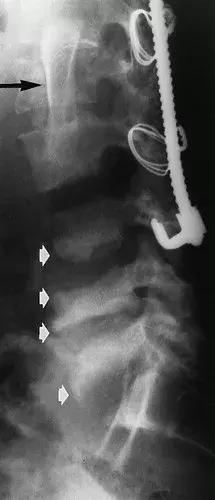 神经性骨关节病,神经性关节炎症状图片