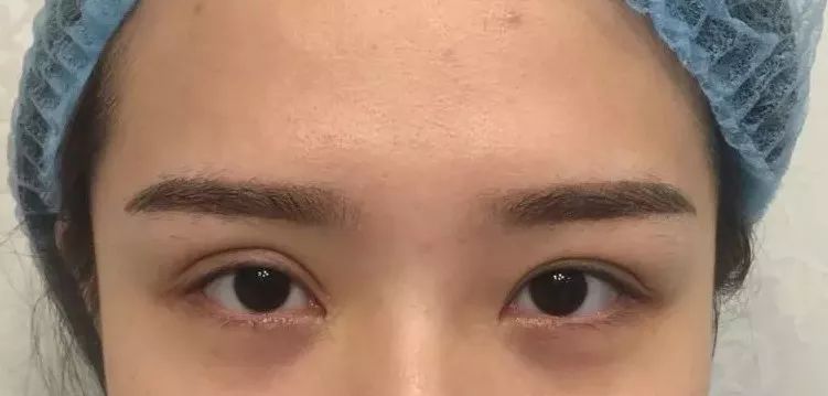 双眼皮术后肿胀不对称是失败了吗,双眼皮术后严重不对称怎么办