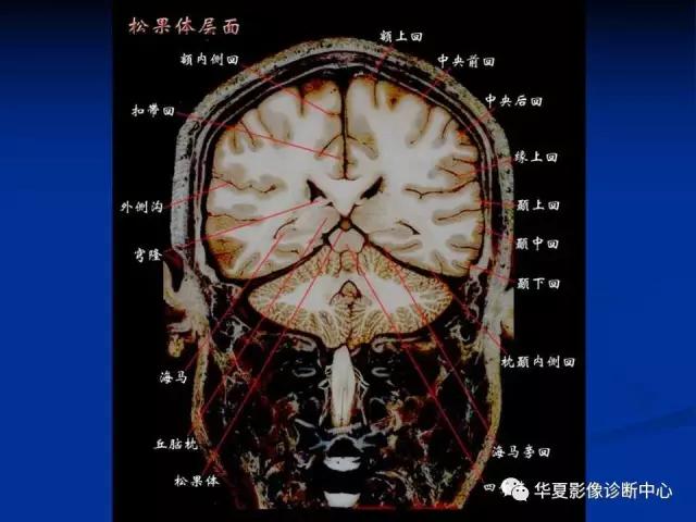 mra头颅解剖学详细讲解视频,常见的头颅mri图像