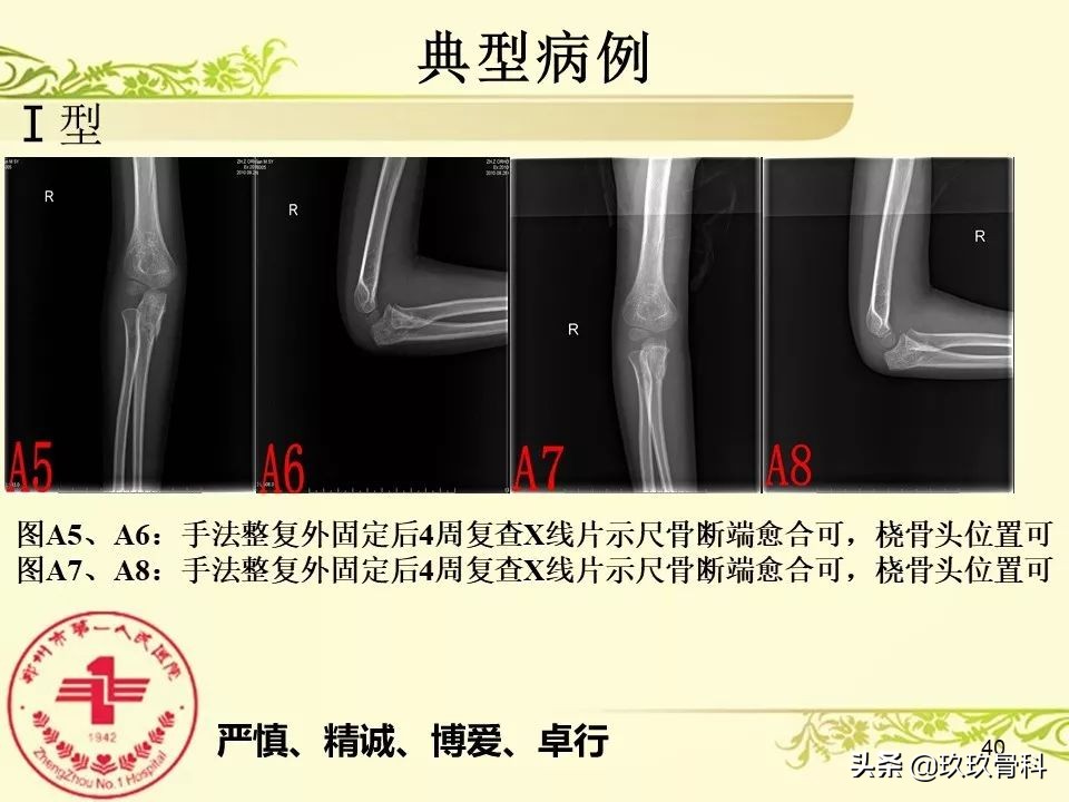 孟氏骨折功能训练多久能恢复正常,孟氏骨折中医能治吗