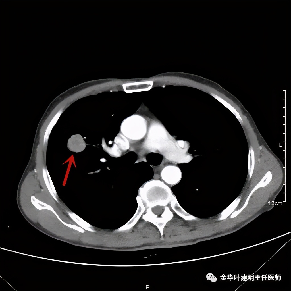 得了肺癌做肺部穿刺有影响吗,肺部穿刺可以确诊肺癌吗