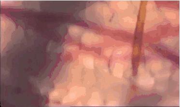 蚊虫叮咬最好的神器,3个月防蚊虫叮咬神器第一名