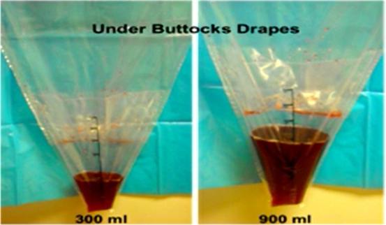 产后出血最新指南ppt,产后出血200毫升多吗