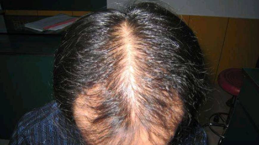 头皮长痘痘什么原因,头皮里面长痘痘是什么原因呢