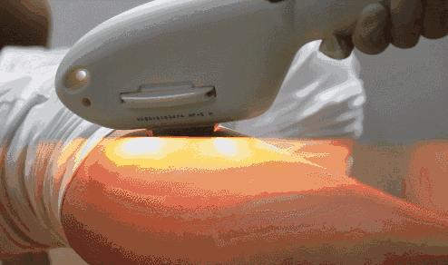 脱毛膏脱毛和拔毛哪个更好,超有效的脱毛膏