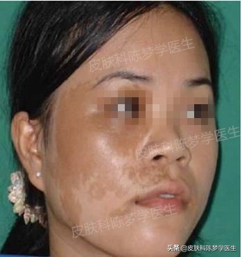 褐青色痣斑吃什么中药好,如何治疗脸上褐青色痣样斑