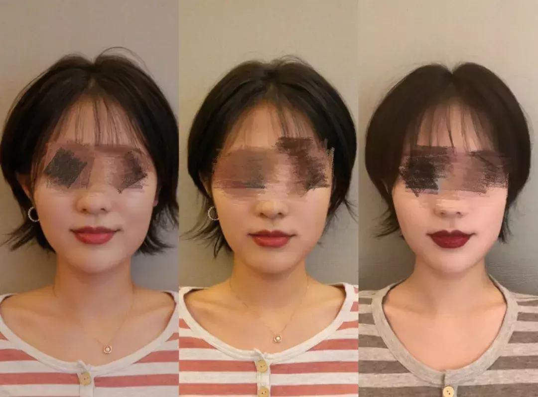 日式小颜整骨需要具备什么,日式小颜整骨术可以把额头变宽吗