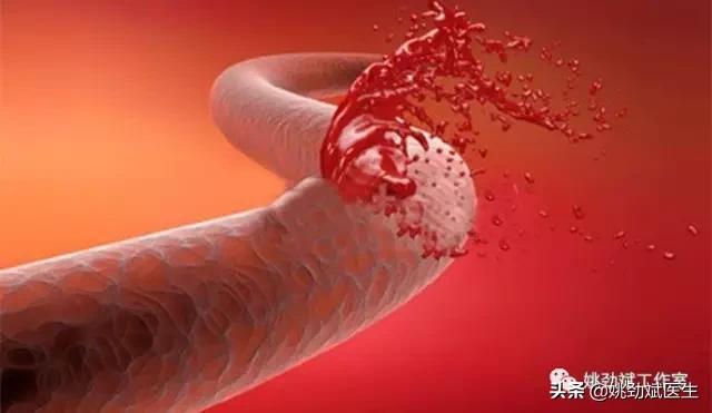 大便带血鲜红不疼吃啥西药,大便偶尔带血是怎么回事