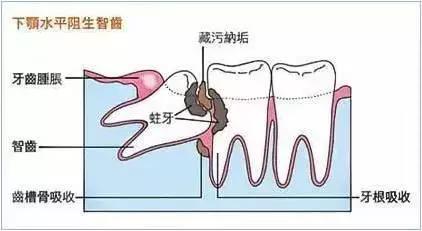 智齿冠周炎引起的下颌骨疼痛,智齿冠周炎张口受限伴吞咽疼痛