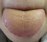 中医舌诊从零开始学齿痕舌,国医大师柴嵩岩舌诊